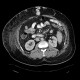 Caput medusae, liver cirrhosis, alcoholic liver cirrhosis, portal hypertension, splenomegally: CT - Computed tomography